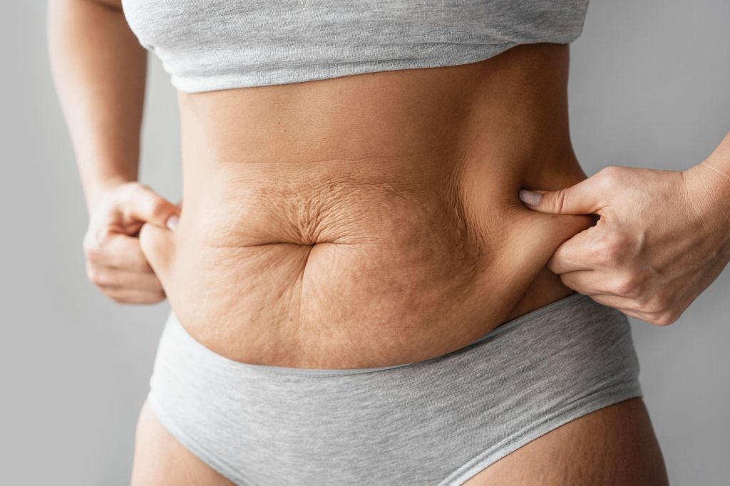 Stretch mark treatments at New Shape by Bouchra in Qatar