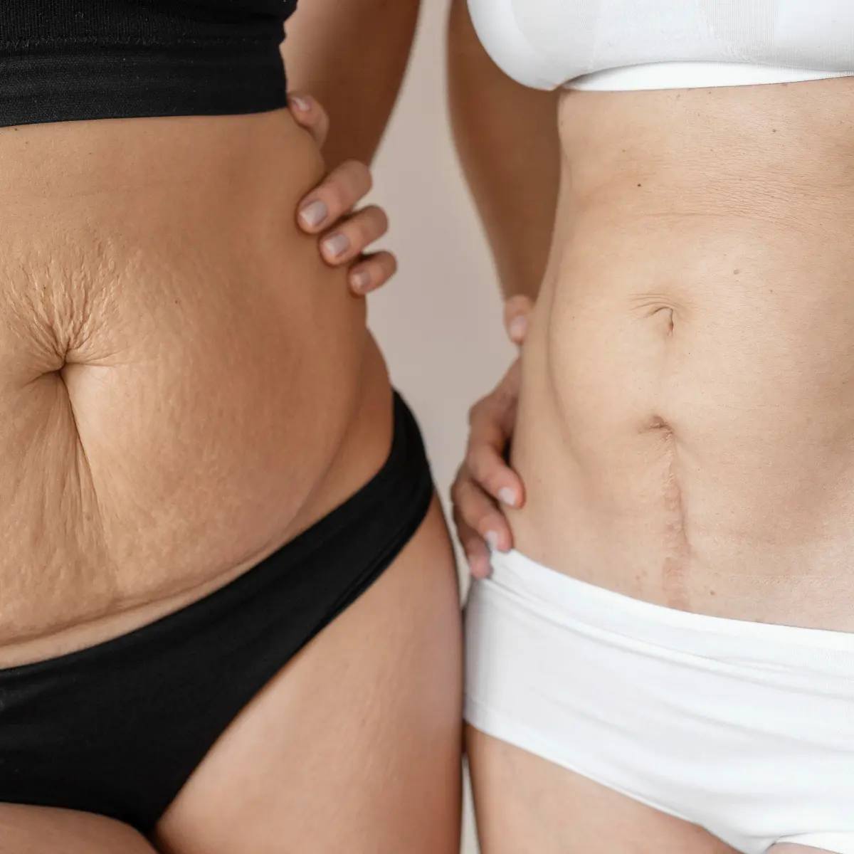 Postpartum stretch mark treatment at New Shape by Bouchra